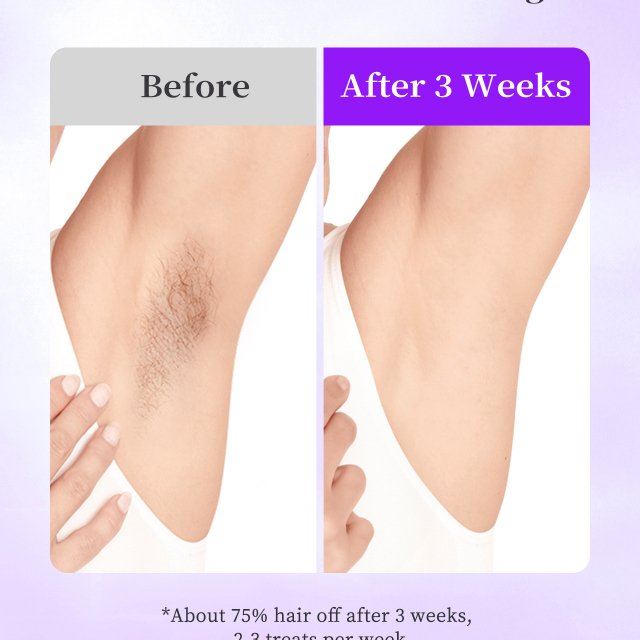 IPL Laser Hair Removal Device - Image 6