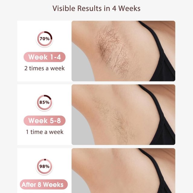 Permanent IPL Laser Hair Removal Device - Image 6
