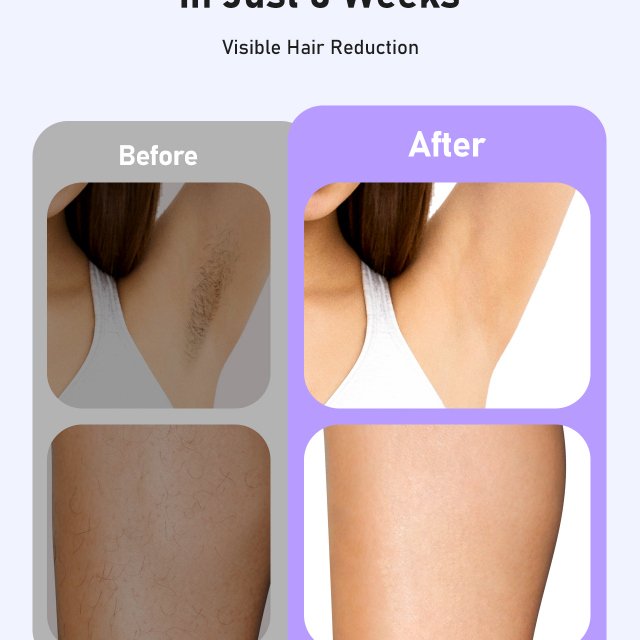 IPL Laser Hair Removal Device - Image 6