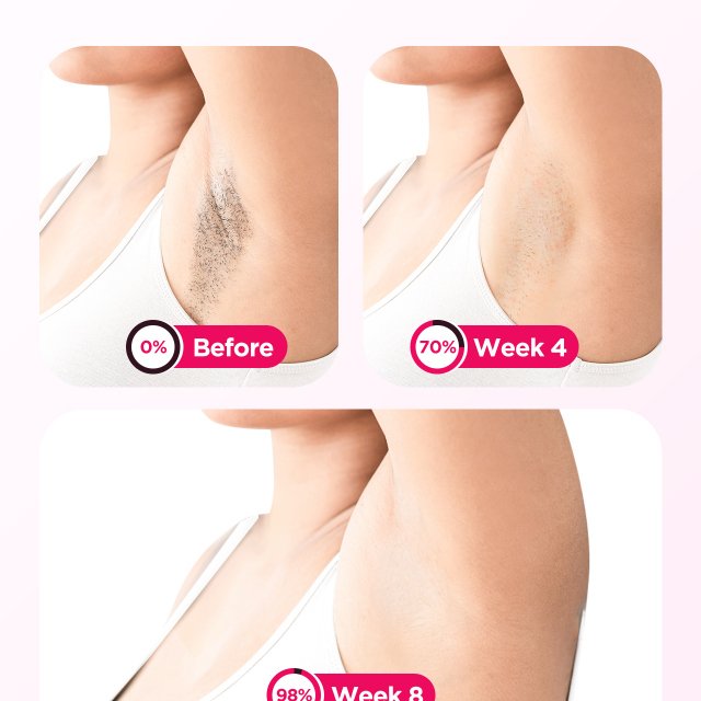 IPL Laser Hair Removal Device with Ice Cooling - Image 6